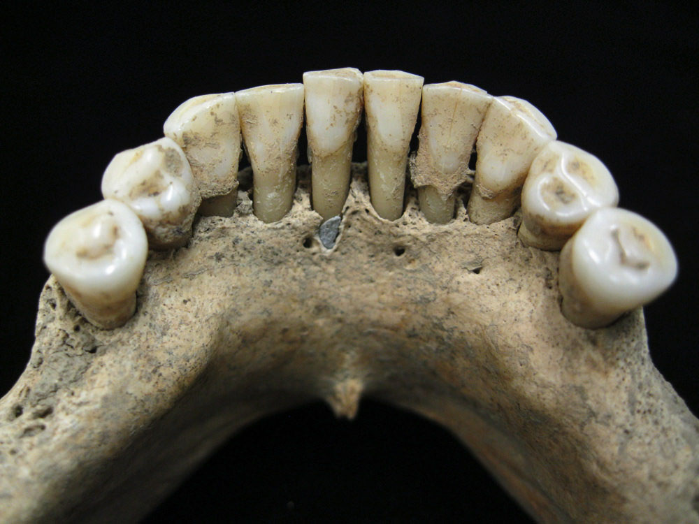 Fotografía de la dentadura de B78 con restos de lapislázuli